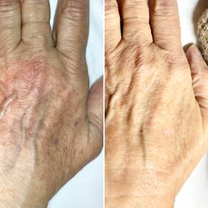 IPL Hand Treatment
