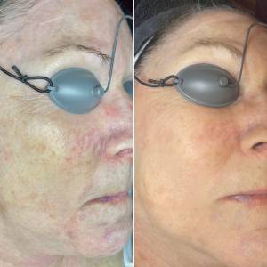 IPL Photofacial