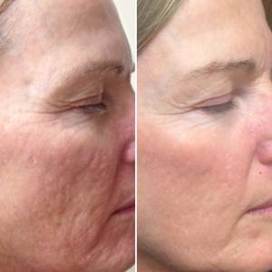 Microneedling
