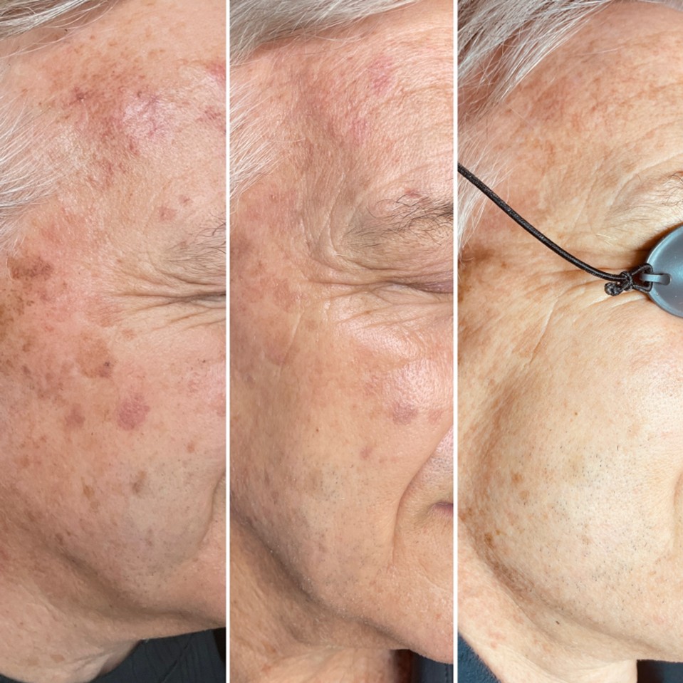 Men's IPL skin treatment