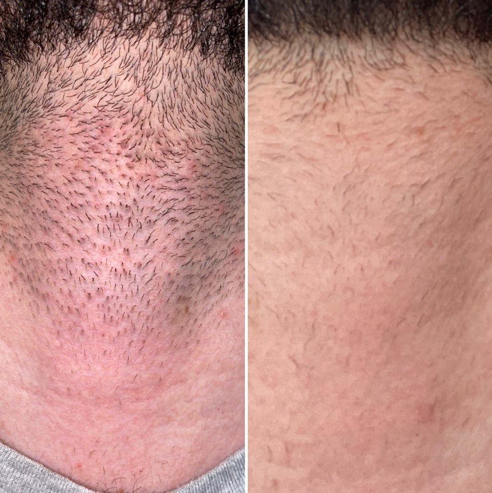 Men's laser hair removal