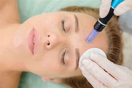 Microneedling treatment at Phiz Spa in Salem
